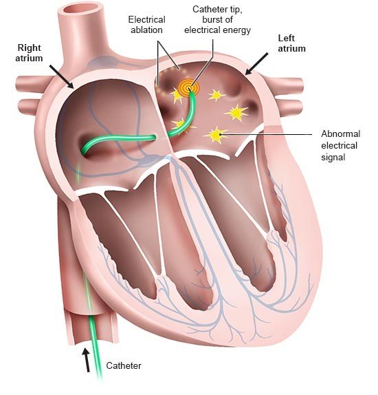ablation